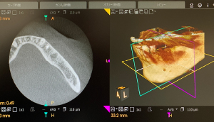 ◀︎ CTで撮影したレントゲン写真データ反映