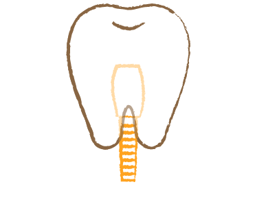 自分の歯のように自然な歯 インプラント