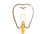 自分の歯のように自然な歯 インプラント